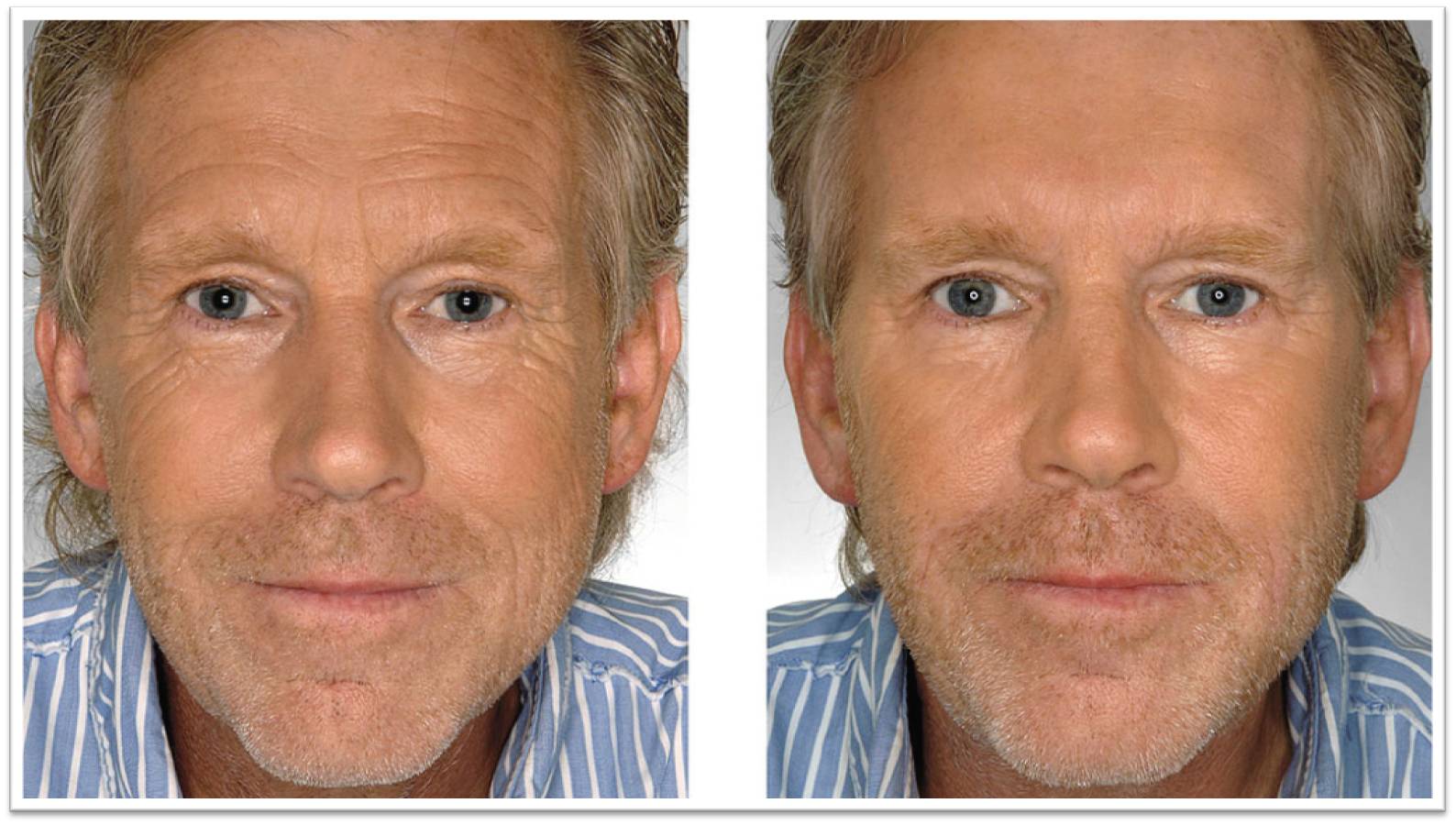 Before and After Results